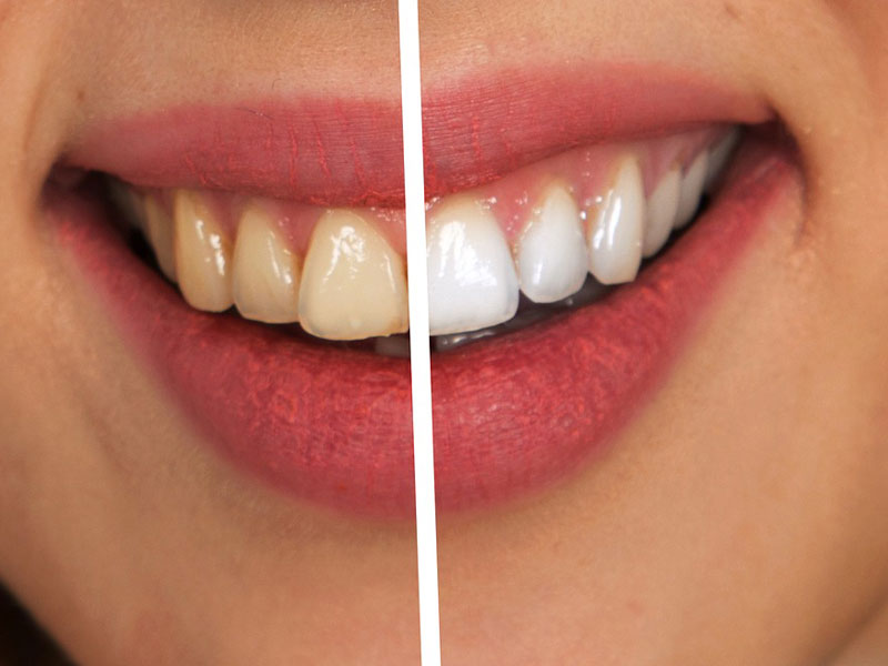 Beli i zdravi zubi: Rešite se zubnog kamenca i sačuvajte svoje zdravlje!