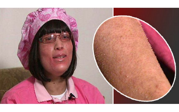 Medicinski fenomen: Ženi umesto dlaka rastu nokti (Foto)
