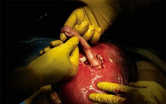 Ruka nade: Beba iz stomaka uhvatila za prst doktora koji joj je spašavao život! (Foto)