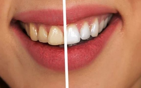 Izbeljivanje zuba na prirodan način! Šta sve utiče na lošu boju zuba!