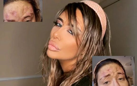 Ana Nikolić ima problem sa licem! Stanje kože kritično! (VIDEO)