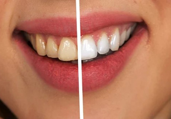 Izbeljivanje zuba na prirodan način! Šta sve utiče na lošu boju zuba!