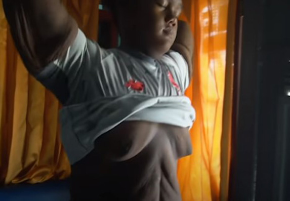 Arija Permana, najdeblje dete na svetu: Smršao je 110 kilograma! (VIDEO)