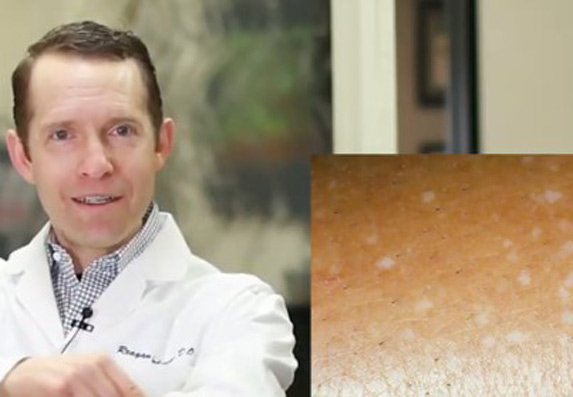 Bele tačke na koži: Šta uzrokuje IGH i kako se leči?