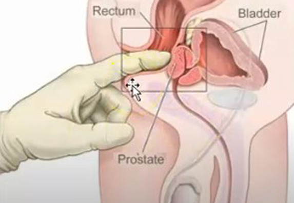 nebakterijska upala prostate simptomi
